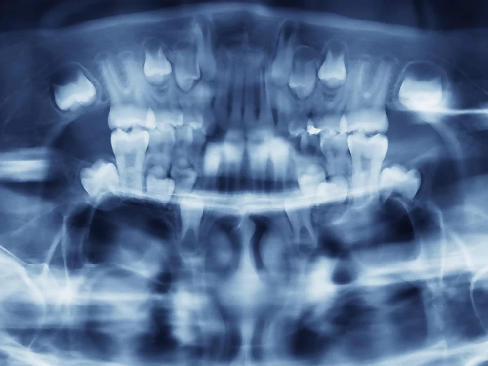 Digital X-Rays Digital X-Rays